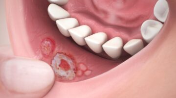 Por que surgem aftas na boca? Veja sintomas e formas de tratamento