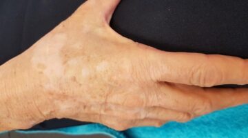 Entenda o que é Vitiligo, além de principais sintomas e tratamento