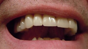 Prótese dentária: como higienizar corretamente cada tipo, segundo especialista